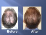 Hair Transplant Before and After Picture