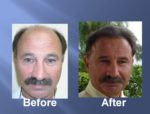 Hair Transplant Before and After Picture