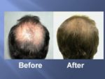 Hair Transplant Before and After Picture