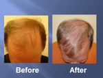 Hair Transplant Before and After Picture