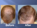 Hair Transplant Before and After Picture