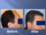 Hair Transplant Before and After Picture