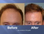 Hair Transplant Before and After Picture