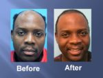 Hair Transplant Before and After Picture