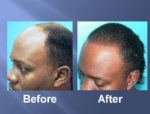 Hair Transplant Before and After Picture