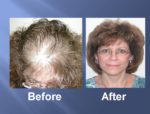 Hair Transplant Before and After Picture