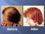 Hair Transplant Before and After Picture