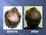 Hair Transplant Before and After Picture