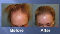 successful hair transplant before and after pics