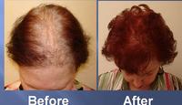 successful hair transplant before and after pics