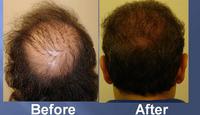 successful hair transplant before and after pics