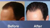 successful hair transplant before and after pics