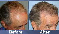successful hair transplant before and after pics
