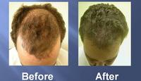successful hair transplant before and after pics