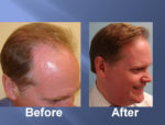 Hair Transplant Before and After Picture